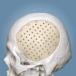 Craneomaxilofacial PEEK03