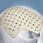 Craneomaxilofacial PEEK04