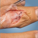 OrthoWrap®03.jpg