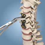 Placa Cervical Anterior04
